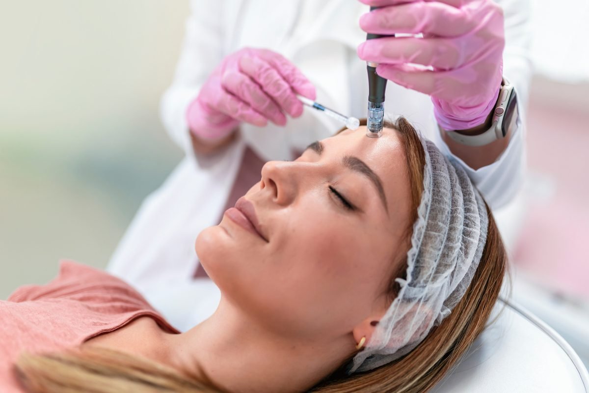 RF Microneedling at Skin Bliss