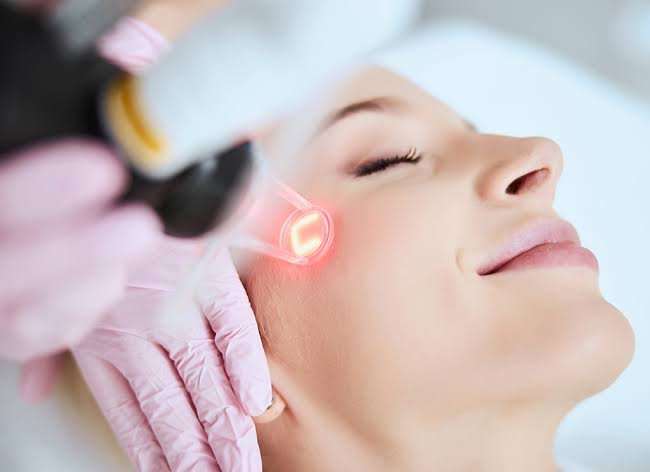 Fractional CO2 laser treatment at Skin Bliss