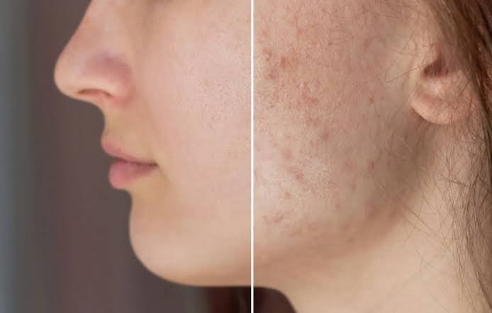Acne scar treatment at Skin Bliss