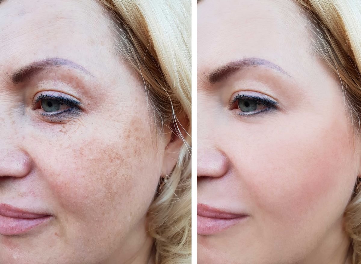 Pigmentation treatment at Skin Bliss
