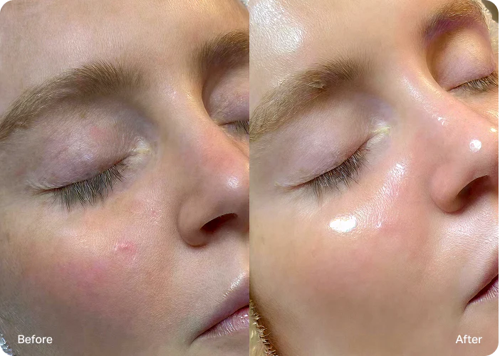 HydraFacial treatment at Skin Bliss