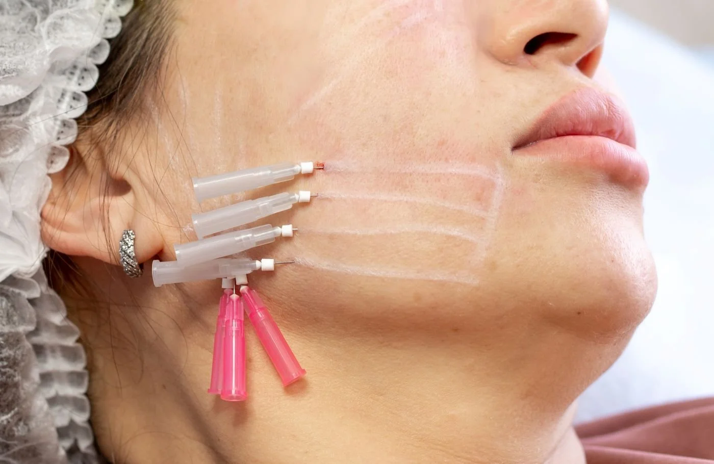 Thread lift treatment at Skin Bliss