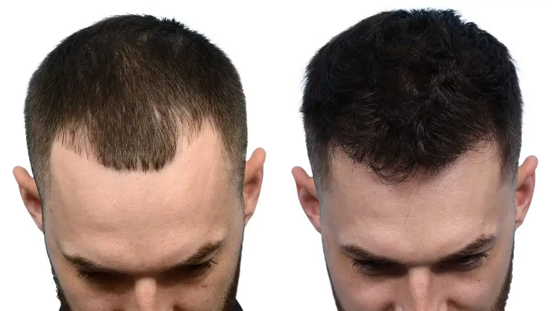 Hair transplant at Skin Bliss