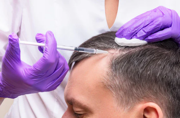 Hair loss treatment at Skin Bliss